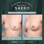 Résultats avant et après augmentation mammaire chez SAERO Plastic Surgery, 1 mois post-op