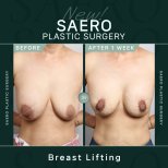 Résultats avant et après lifting mammaire chez SAERO Plastic Surgery, effet visible après 1 semaine