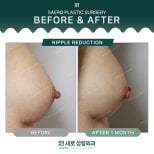 Результати зменшення сосків до і після в SAERO Plastic Surgery, помітне покращення