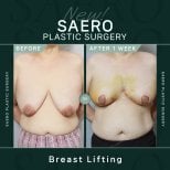 Результати до і після підтяжки грудей у SAERO Plastic Surgery, помітний ефект за 1 тиждень