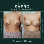 Результати до і після підтяжки грудей у SAERO Plastic Surgery, помітний ліфт через 1 тиждень