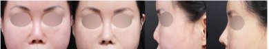 Результати до та після корекції рубців у VG Plastic Surgery, покращення шкіри обличчя