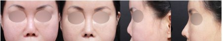 Результати до та після корекції рубців у VG Plastic Surgery, покращення шкіри обличчя