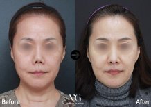 Результати до та після корекції рубців у VG Plastic Surgery, покращення шкіри обличчя
