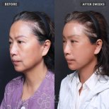 نتائج شد الوجه العميق قبل وبعد في VG Plastic Surgery، تجديد شباب الوجه بوضوح