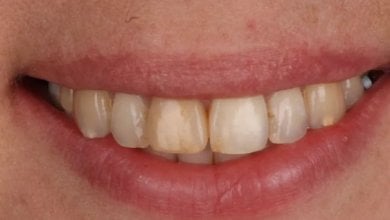 Before veneers treatment at Dental Clinic Dynasty Stomatology in Krakow, natural teeth visible