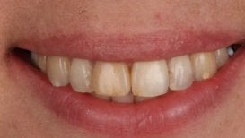 Before veneers treatment at Dental Clinic Dynasty Stomatology in Krakow, natural teeth visible