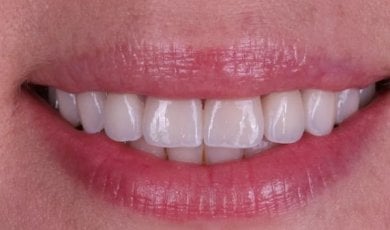 Veneers result at Dental Clinic Dynasty Stomatology in Krakow – bright, natural-looking smile