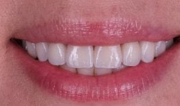 Veneers result at Dental Clinic Dynasty Stomatology in Krakow – bright, natural-looking smile