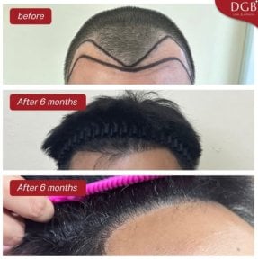 Before and after hair transplant at DGB Clinic – natural hairline results after 6 months