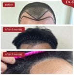 Before and after hair transplant at DGB Clinic – natural hairline results after 6 months