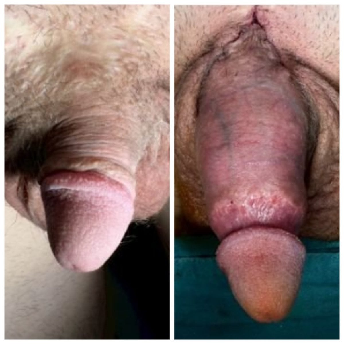 Resultados antes y después de alargamiento de pene quirúrgico en Menness Wellness Clinic