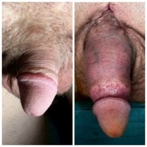 before-after photo surgical-penile-lengthening