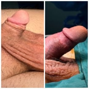 before-after photo surgical-penile-lengthening