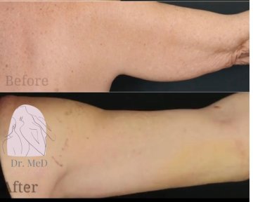 before-after photo abdominoplasty