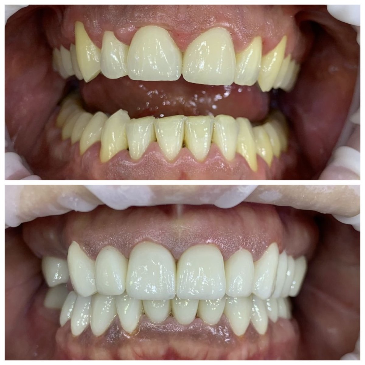 قبل وبعد الفينير في Smile Terminal Dental Care – ابتسامة محسنة ونتيجة أسنان أكثر بياضًا