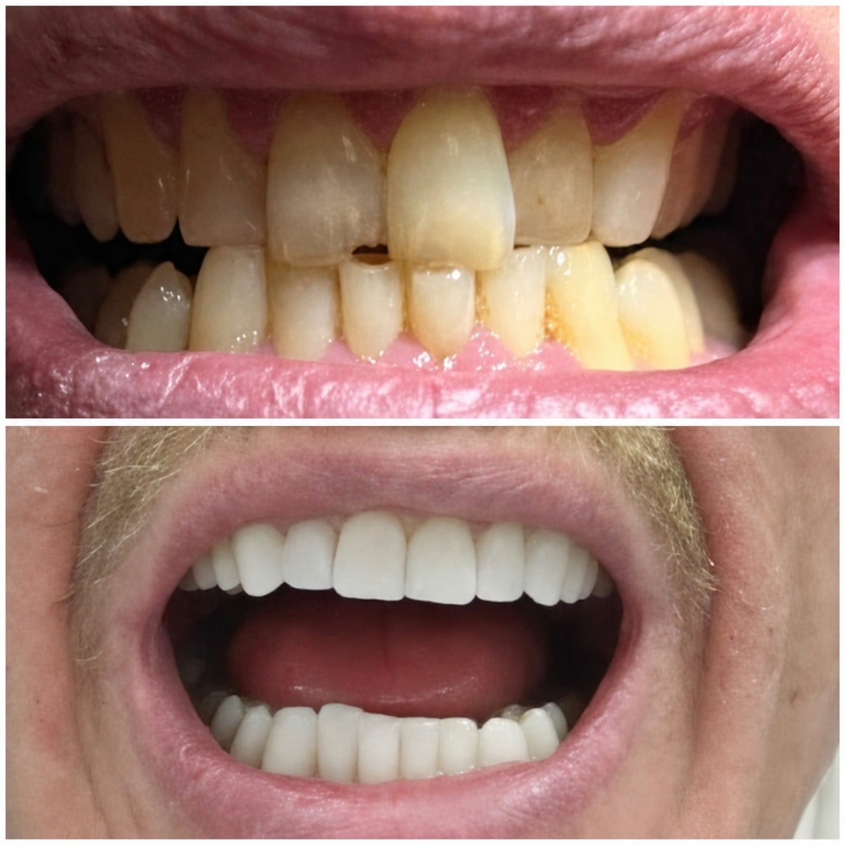 نتائج تنظيف الأسنان (إزالة الجير) قبل وبعد في Dential Dental Clinic، ابتسامة أكثر بياضًا