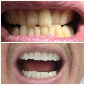 Resultados de limpieza dental (scaling) antes y después en Dential Dental Clinic, sonrisa más blanca