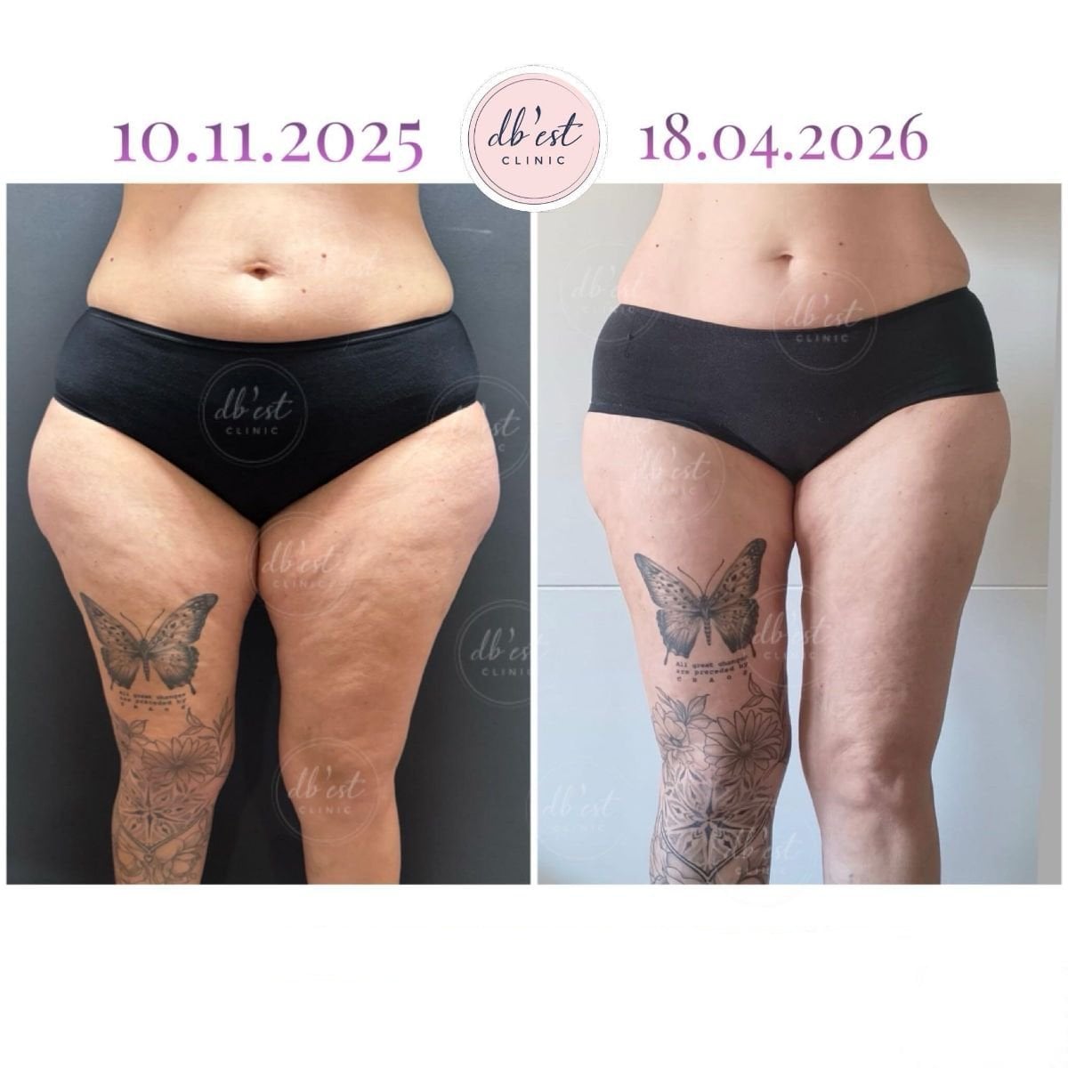Resultados antes y después de liposucción Vaser en Db'est Clinic, mejora visible de muslos