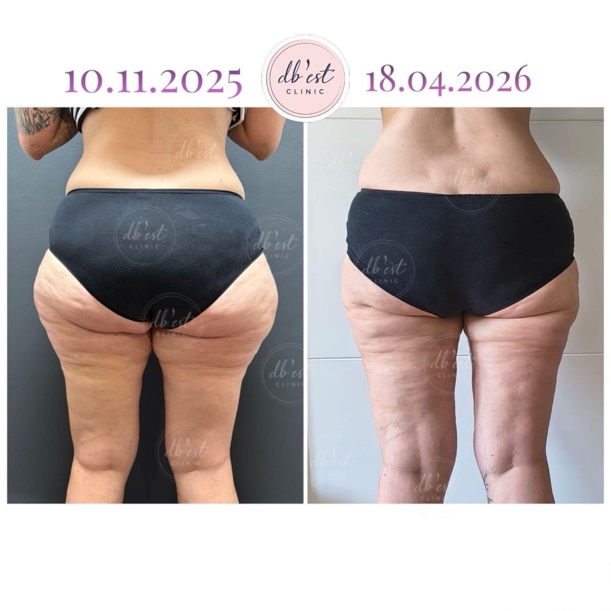 Resultados antes y después de liposucción Vaser en Db'est Clinic – contorno mejorado