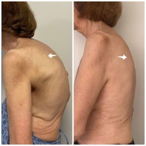 before-after photo scoliosis-surgery