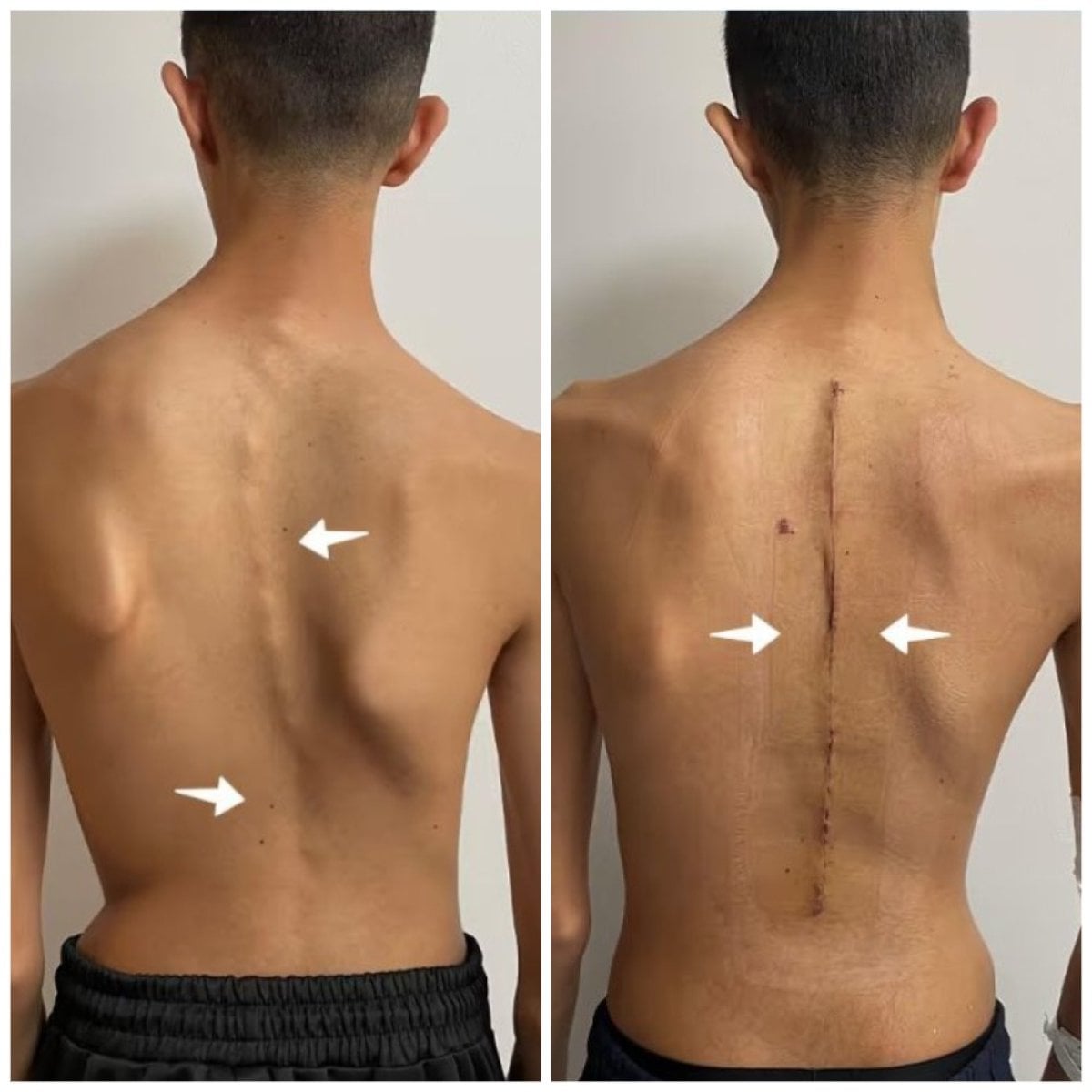 Resultados antes y después de cirugía de escoliosis en Central Hospital, columna alineada