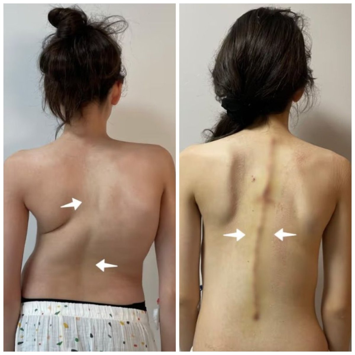 Resultado antes y después de cirugía de escoliosis en Central Hospital – alineación mejorada