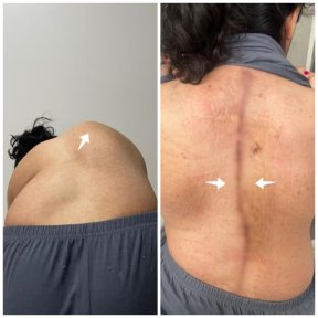 before-after photo scoliosis-surgery
