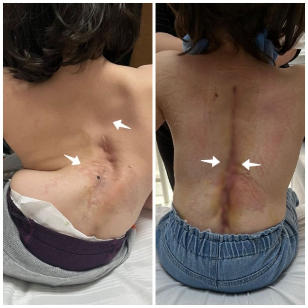 Resultados antes y después de cirugía de escoliosis en Central Hospital – alineación mejorada