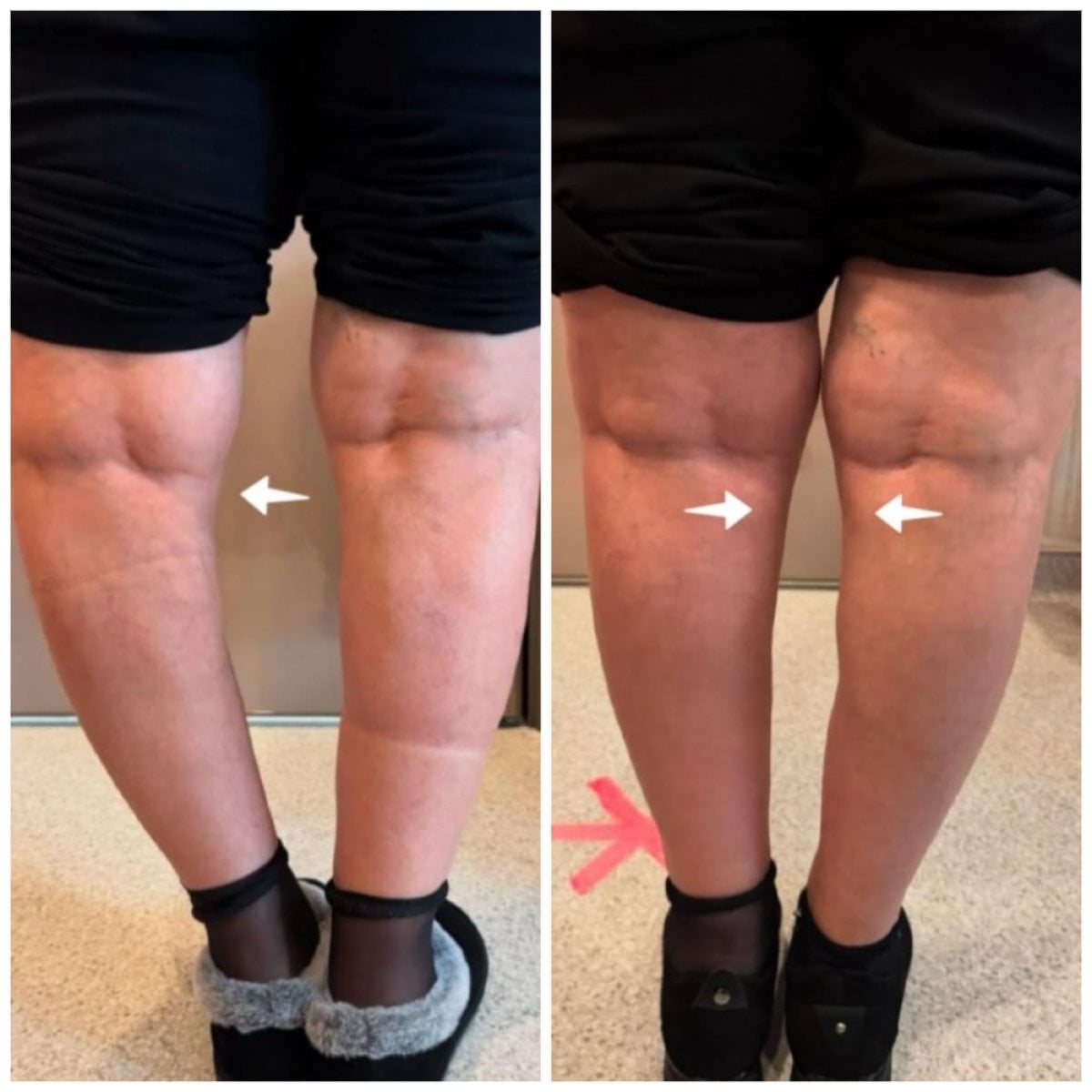 Antes y después de reemplazo de rodilla en Central Hospital, mejor alineación y menos hinchazón