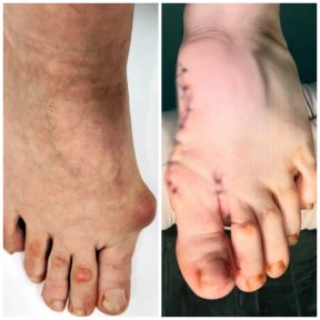 before-after photo hallux-valgus-surgery