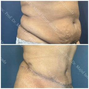 Before and after tummy tuck results at Central Hospital, visible abdominal contour improvement