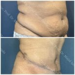 Before and after tummy tuck results at Central Hospital, visible abdominal contour improvement
