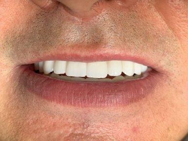 before-after photo all-on-6-dental-implants