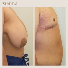 before-after photo female-to-male-ftm-surgery