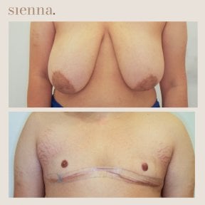 before-after photo female-to-male-ftm-surgery
