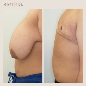 before-after photo female-to-male-ftm-surgery