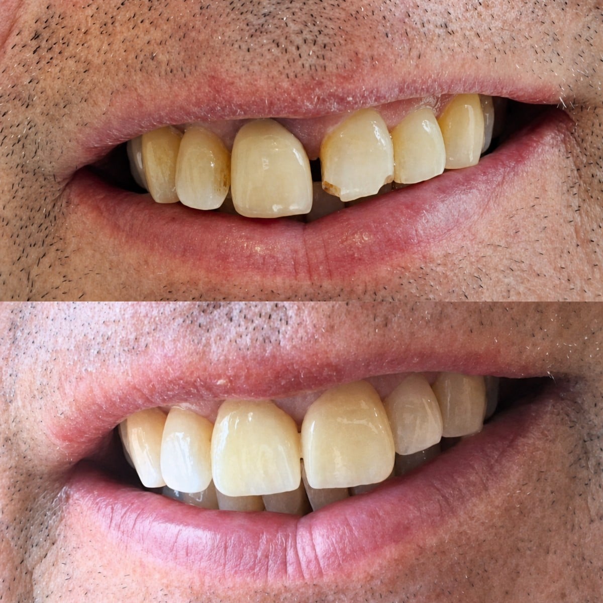 نتائج قبل وبعد تركيب تيجان الأسنان في Clínica Dental Raíces، ابتسامة مستعادة