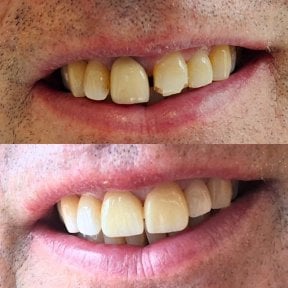 before-after photo dental-crown-installation