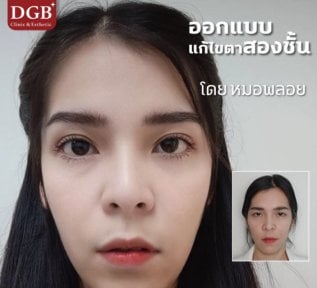 Resultados de blefaroplastia de párpado inferior antes y después en DGB Clinic, área mejorada