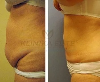 Before and after liposuction results at Klinika Elite – visible abdominal contour improvement