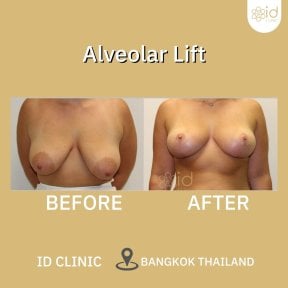 before-after photo mastopexy-breast-lift-contour-plastics