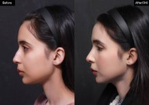 Resultados de rinoplastia antes y después en VG Plastic Surgery, perfil nasal mejorado