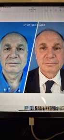Before and after lower eyelid blepharoplasty results at Memorial Şişli Hospital, rejuvenated look