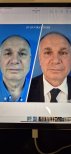 Before and after lower eyelid blepharoplasty results at Memorial Şişli Hospital, rejuvenated look