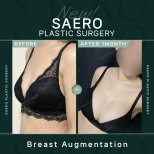 Before and after breast augmentation results at SAERO Plastic Surgery, 1 month post-op