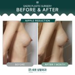 Before and after nipple reduction results at SAERO Plastic Surgery, improved breast appearance