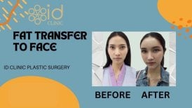 نتائج قبل وبعد حقن الدهون للوجه في ID Clinic Bangkok، تعزيز حجم الوجه
