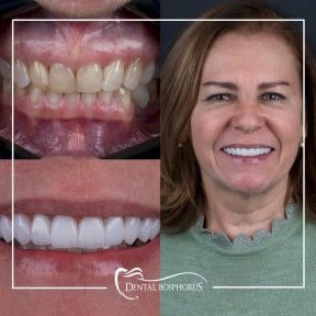 Resultados antes y después de implantes dentales en Dental Bosphorus, sonrisa y alineación mejoradas
