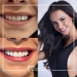 Resultados antes y después de implantes dentales en Dental Bosphorus, sonrisa mejorada